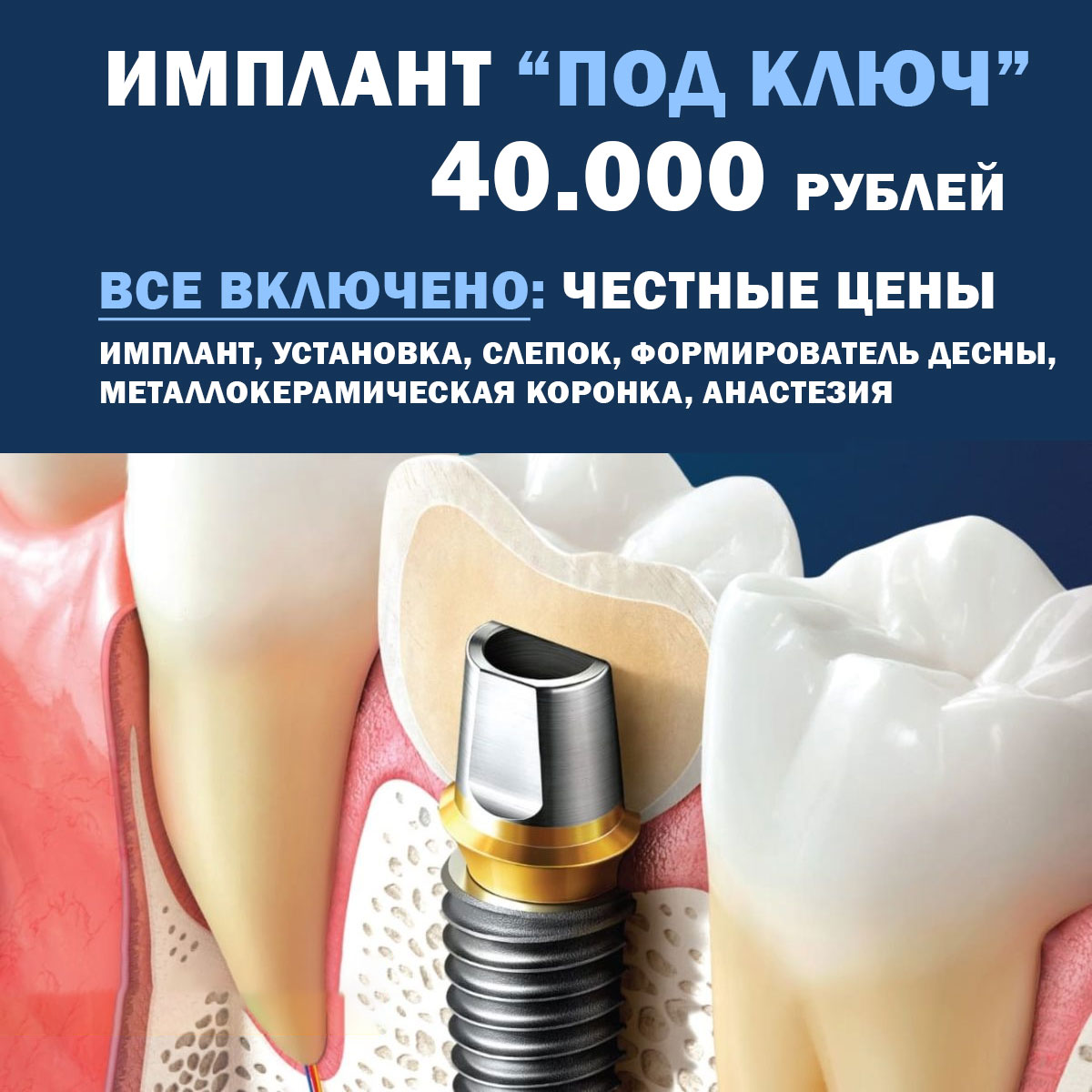 Имплант под ключ 40.000