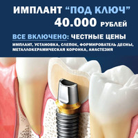 Имплант под ключ 40.000